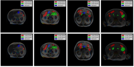 Segmentation of Gastrointestinal Tract Cancer Using Enhanced Attention U-Net and MRI Scans: Model predictions (top) and ground truth (bottom)